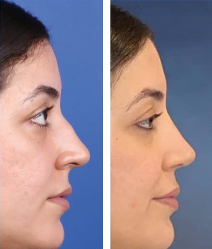Rinoplastia caso 23 — antes y después